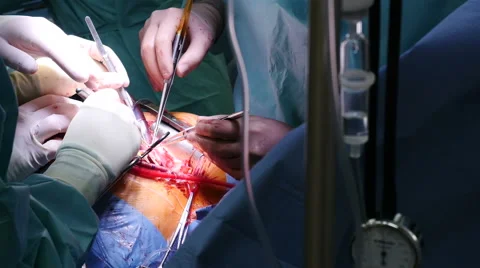 Open heart surgery, Full HD shot Stock-Footage 59022067