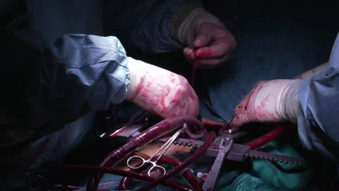 Open-heart surgery, hands with tools and tubes Video stock 342798799