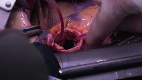 Open-heart surgery, knots tied on the aorta Video stock 342799112