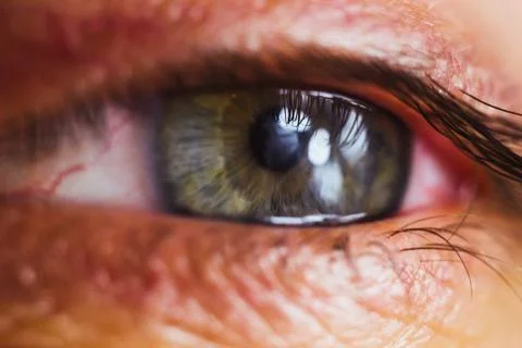 Open human eye with bright red arteries close up. irritation and redness of t Stock Photos