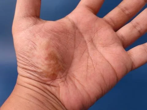 An open human palm with a slightly discolored patch skin condition is displ.. Stockfoto's