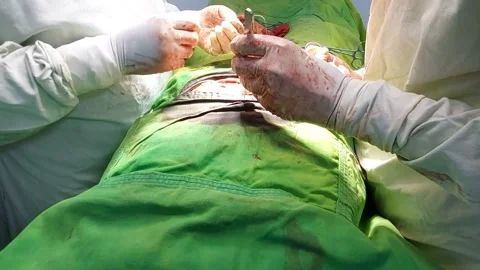 Open laparotomy abdomen Stock Footage 246980878