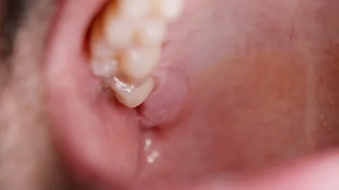 Open Mouth After Wisdom Tooth Extraction Stock Footage 333495446