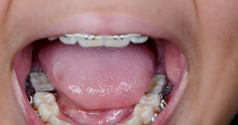 Open mouth and exposing the braces Video stock 286746162