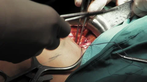 Open vein surgery Stock-Footage 67286379