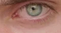 opening and closing of one eye of young man very sad - tears - allergy HD Footage