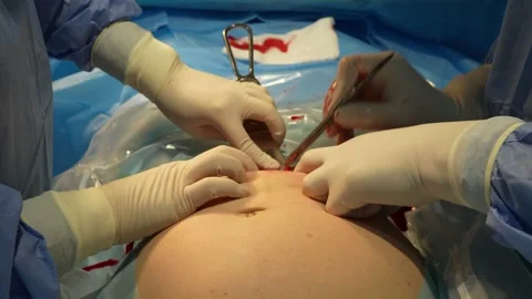 Opening of the fetal bladder during caesarean section. Stock Footage 235458542