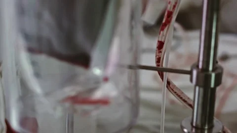 Operating. Laparoscopic surgery. The blood is pumped out. Vídeo Stock 77397861