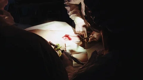 Operating. Laparoscopic surgery. Close-up. Vídeo Stock 77397331