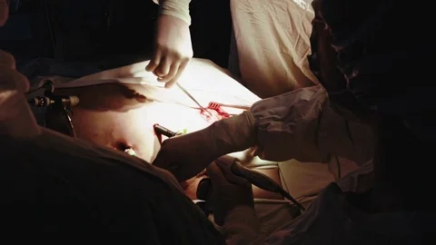 Operating. Laparoscopic surgery. Close-up. Stock Footage 77397502