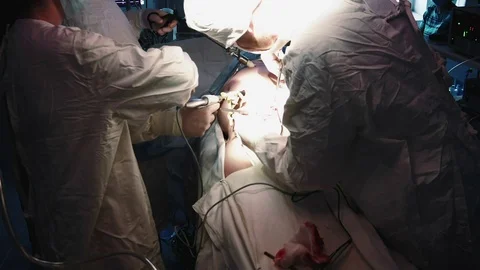 Operating. Laparoscopic surgery. Close-up. Stock Footage 77397885