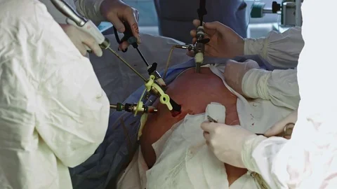Operating. Laparoscopic surgery. Close-up. Stock Footage 77397943