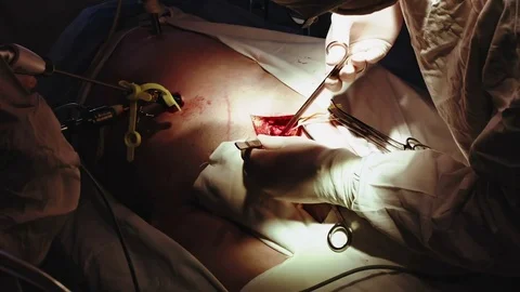 Operating. Laparoscopic surgery. Close-up. Stock Footage 77397964