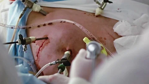 Operating. Laparoscopic surgery. Close-up. Stock Footage 77397970
