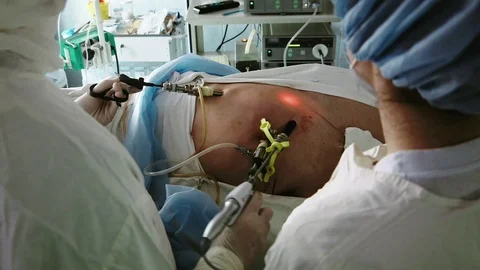 Operating. Laparoscopic surgery. Close-up. Stock Footage 77398000