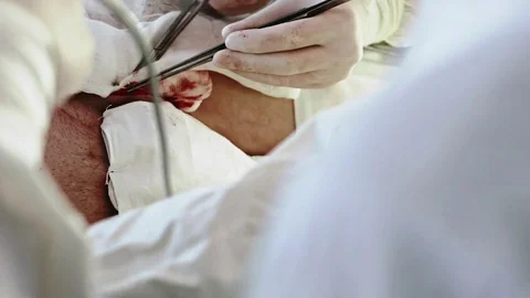 Operating. Laparoscopic surgery. Close-up. Sew incision. Vídeo Stock 77397996