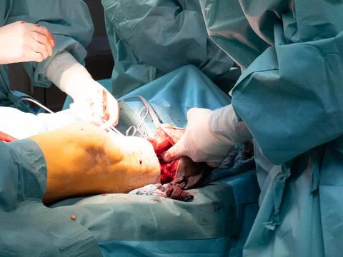 In an operating room lower leg amputation is performed Stock Photos