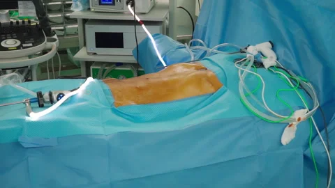 An operating room with a patient lying on the table. An open abdomen prepar.. Stock Footage 334856286