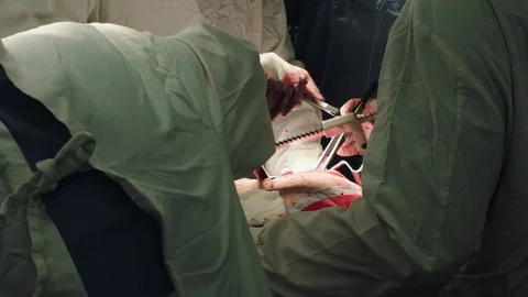 Operating. Surgery. Heart surgery. Stock Footage 77385005