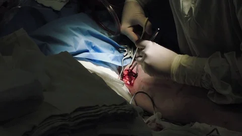 Operating. Surgery. Heart surgery. Stock Footage 77385016