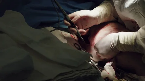 Operating. Surgery. Heart surgery. Stock Footage 77385024
