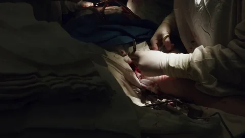 Operating. Surgery. Heart surgery. Stock Footage 77385034