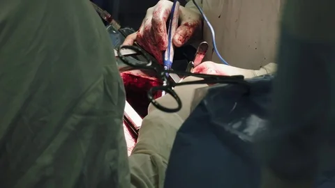Operating. Surgery. Heart surgery. Stock Footage 77385043