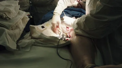 Operating. Surgery. Heart surgery. Stock Footage 77385052