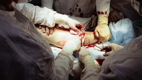 Operating. Surgery. Operation of varicose veins. Vídeo Stock 77385049