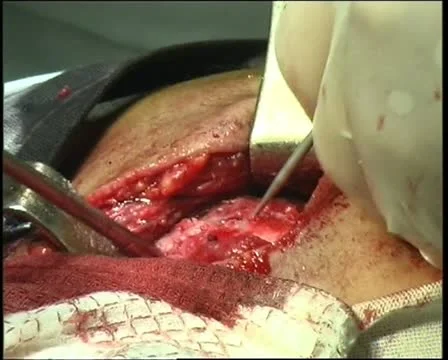 Operating table Stock Footage 11359231