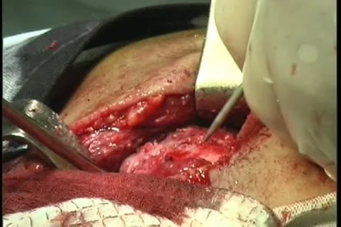 Operating table Stock Footage 11359232