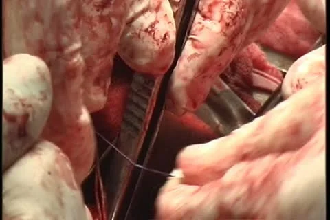 Operating table Stock Footage 11359252