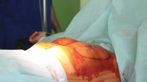 On the operating table lies a patient with breast treated before surgery 스톡 동영상 123570331