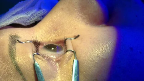 The operation on the eye. Cataract surgery. blepharostat Stock Footage 70658649