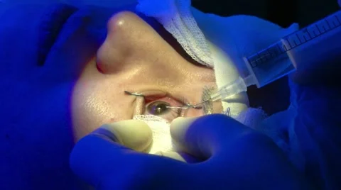 The operation on the eye. Cataract surgery Vidéo 66508903