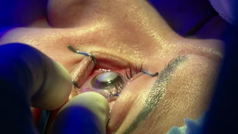 The operation on the eye. Cataract surgery Stock Footage 69892815