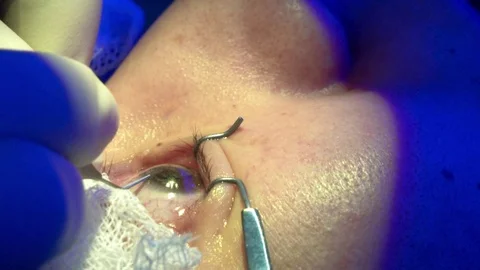 The operation on the eye. Cataract surgery Stockbeeldmateriaal 70657999