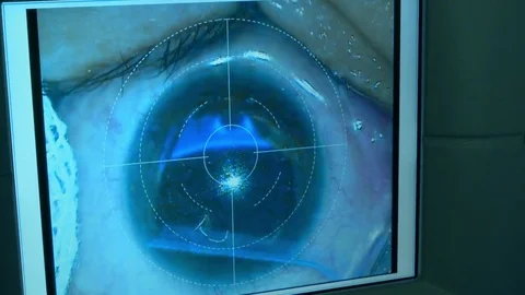 The operation on the eye. Cataract surgery Stock Footage 73311266