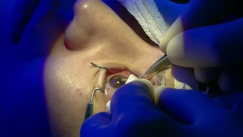 The operation on the eye. Cataract surgery Stock Footage 73408655