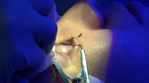 The operation on the eye. Cataract surgery Stock Footage 73408713