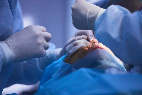 The operation on the eye. Cataract surgery Foto stock