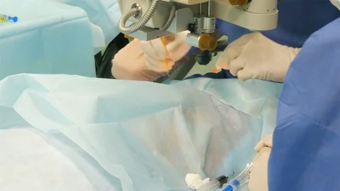Operation on the eye, cataract surgery. Surgeon hands in gloves performing laser Stock Footage 127909893