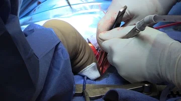 Operation of the heart Stock Footage 85930615