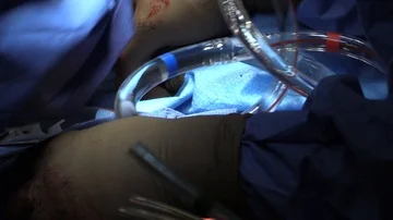 Operation of the heart by surgeons Stock Footage 85931506