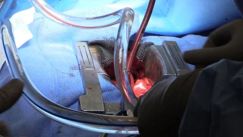 Operation of the heart by surgeons Stock Footage 85933669