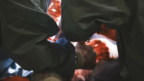 Operation. Hip replacement surgery. The hands of the surgeon. Stock Footage 99877993