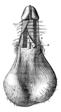 Operation of hypospadias (Process for Th Anger), vintage engraving. Stock Illustration