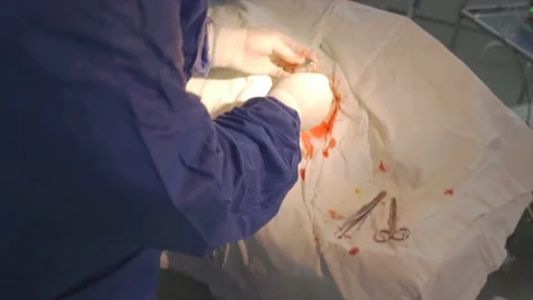 Operation to install a pacemaker. Stock Footage 149770784