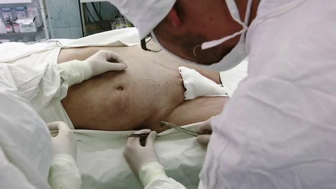 Operation. Laparoscopic surgery. Vídeo Stock 76996557