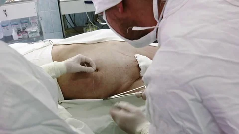 Operation. Laparoscopic surgery. Preparing for an operation. Vídeo Stock 77397467